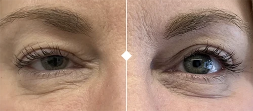 Droopy eyelid correction barcelona