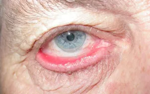 Cirurgia Ectropion
