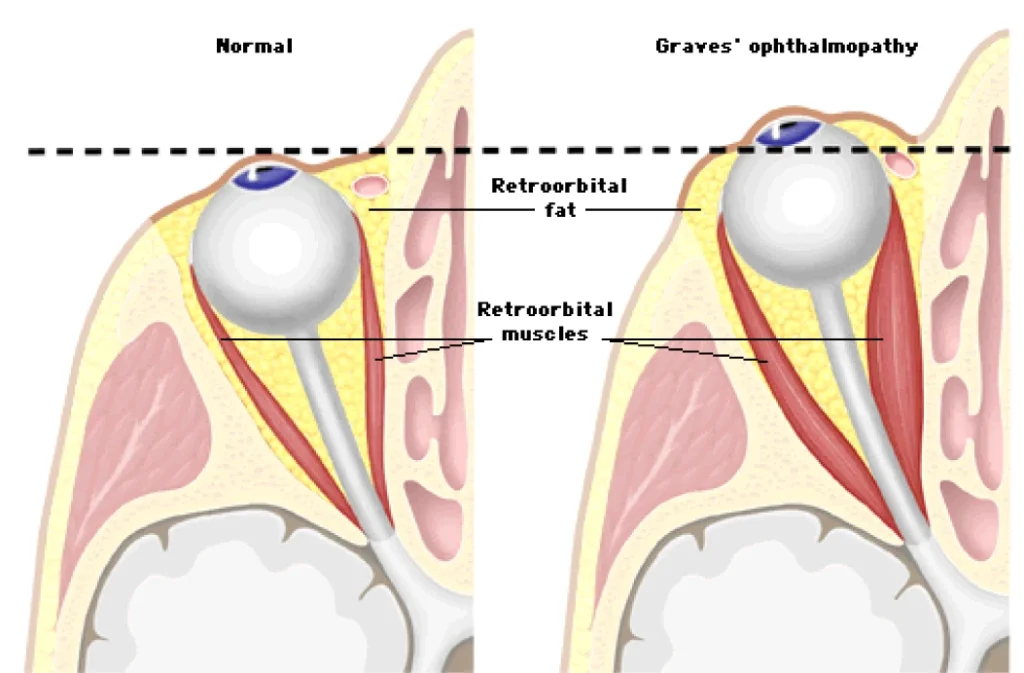 Graves orbitopathy